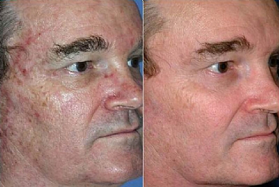 עור לפני ואחרי טיפול בלייזר קטיפה
