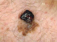 Malignant melanoma 